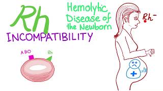 Rh sensitization during Pregnancy  Impotance of Indirect Coombs testing  Dr Shefali Tyagi [upl. by Naenaj]