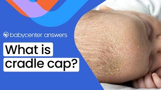 What is cradle cap [upl. by Maggi762]