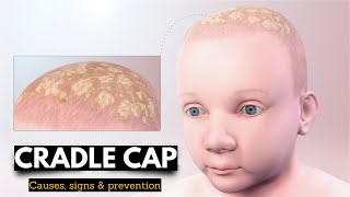 Cradle Cap Causes Signs and Symptoms Diagnosis and Treatment [upl. by Rosenfeld]