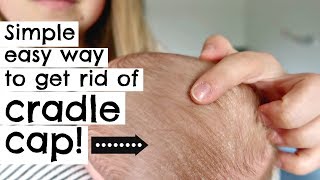 HOW TO GET RID OF CRADLE CAP IN ONE TRY  NEWBORN [upl. by Airelav]