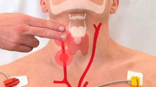 Carotid Sinus Massage 2017 [upl. by Cram470]