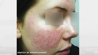 Rosacea relief How to treat persistent facial flushing [upl. by Photina]