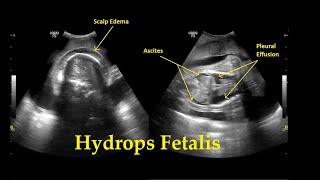 Hydrops Fetalis  Ultrasound  Anomaly  Case 26 [upl. by Carmine]