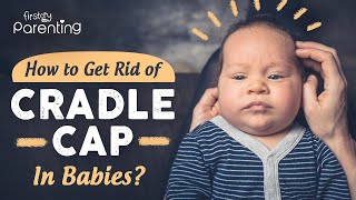 Cradle Cap in Babies  Causes and Remedies [upl. by Sonja572]