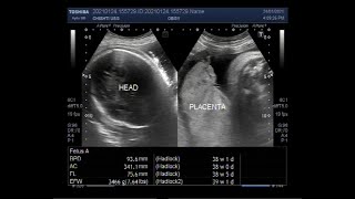 Ultrasound Video showing Hydrops fetalis Soft tissue edeme and Fetal pleural effusion [upl. by Kilmarx]