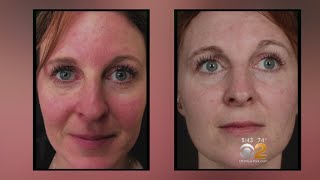 Health Watch New Laser Treatment For Rosacea [upl. by Sjoberg942]