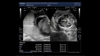 Two large Encephaloceles Hydrops fetalis pericardial effusion ascites and soft tissue edema [upl. by Noguchi]