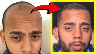 Crazy Minoxidil 5 Hair Growth in 25 Months Fails after 25 YEARS Heres WHY [upl. by Felicity381]