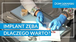 Implanty zębów Dlaczego warto [upl. by Rustie]