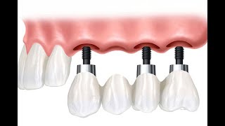 Diş çekimi sonrası implant ve köprü uygulaması [upl. by Eillam]