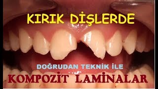 Kırık Ön Dişlerde Kompozit Laminalar 2 [upl. by Rovaert]