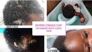 HOW TO TREAT SEVERE CRADLE CAP ON BABIES WITH AFRO CURLY HAIR [upl. by Ellatsyrc]