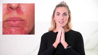 How To Treat Skin Redness  Rosacea  its Causes and Treatments [upl. by Drhacir]