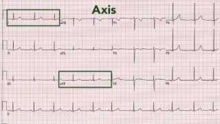 ECG interpretation recognising normal [upl. by Yenwat]