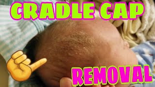 SUPER EASY AND NATURAL WAY TO REMOVE CRADLE CAP [upl. by Naelopan]