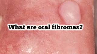 What are oral fibromas Are they benign lesions [upl. by Abihsat11]