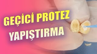 Geçici Protez Simantasyonu [upl. by Detta]