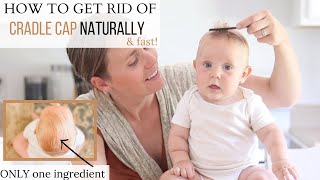 How to Get Rid of Cradle Cap FAST  Best Cradle Cap Remedy [upl. by Frechette]