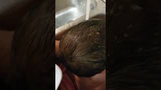 Baby cradle cap removal [upl. by Aivilys328]