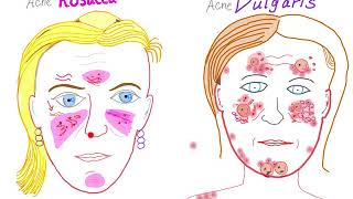 Acne Vulgaris Vs Acne Rosacea [upl. by Edniya475]