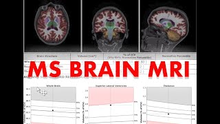 What fMRI Scans tell us about the Adolescent Brain [upl. by Yahsat]